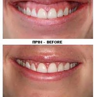 1-gummie-smile