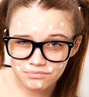 laser_acne